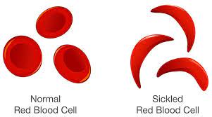 Pre-marriage testing needed to end Sickle Cell